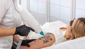 Tattoo Removing Franchise Washington